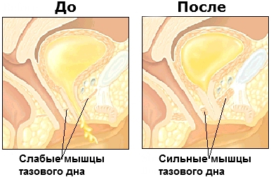 интимные мышцы сравнение